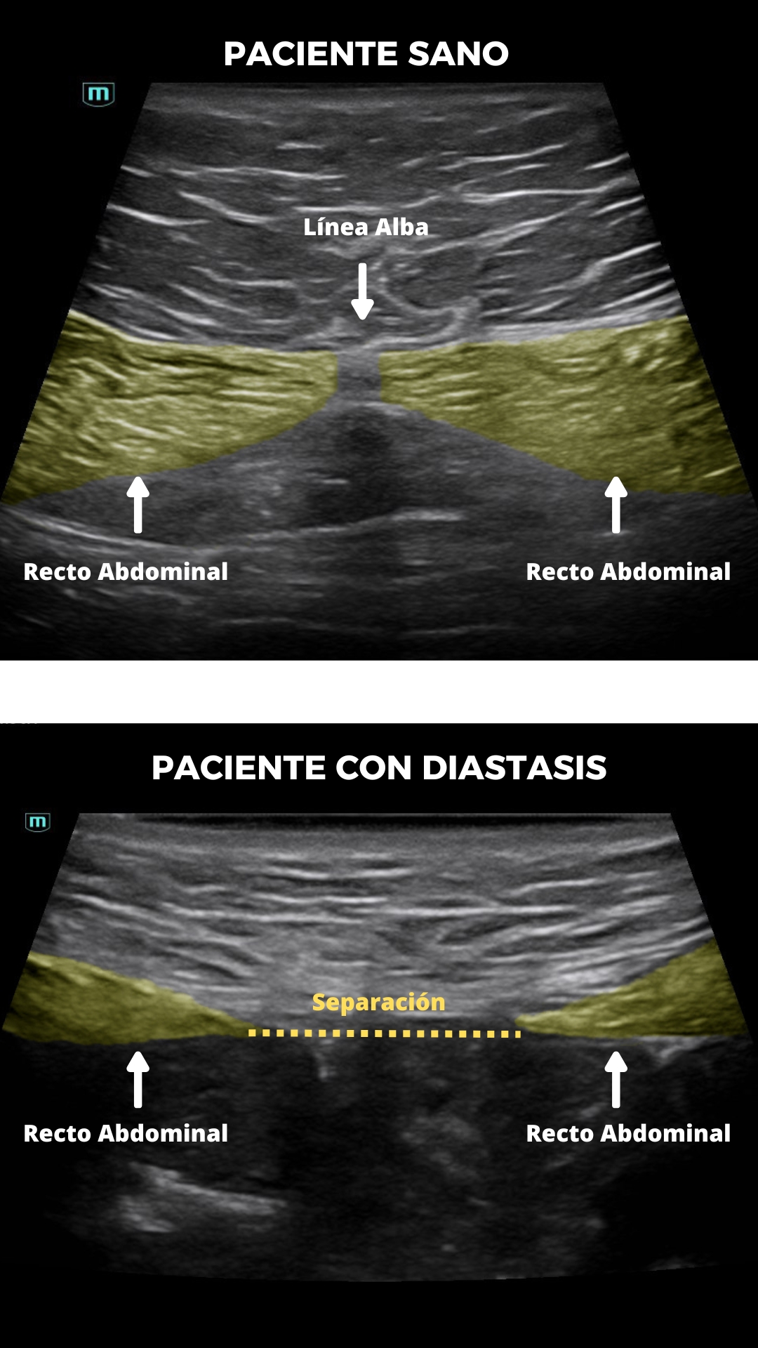 Ecografía controlada en postparto, control de la diastasis abdominal