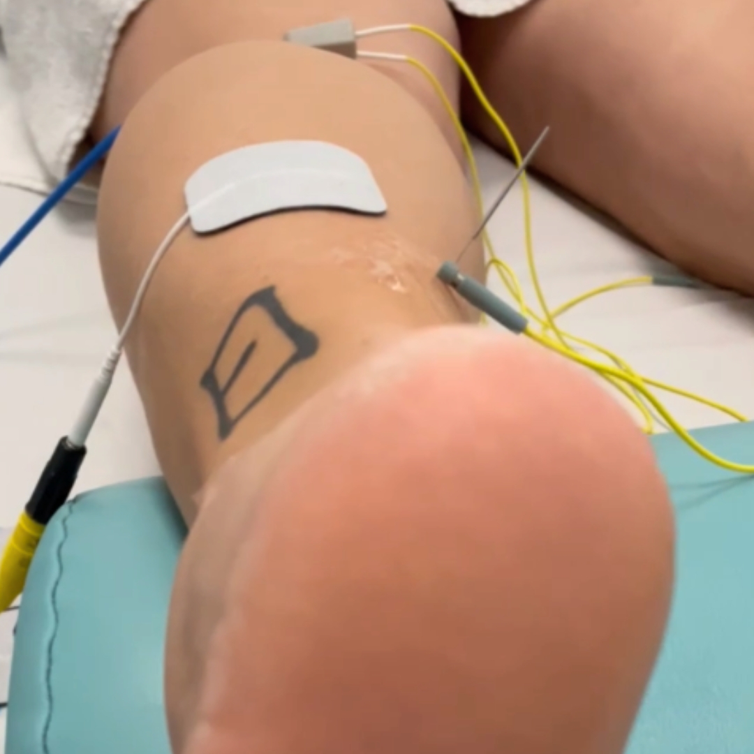 Neuromodulación Percutánea Ecoguiada